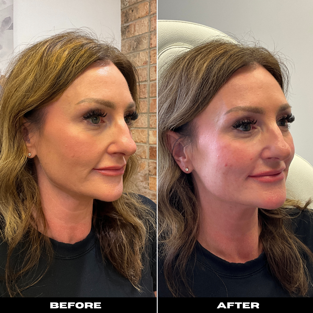 Before and After Image: Belotero - right-front-oblique
