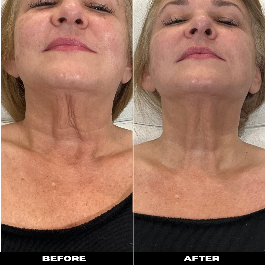 Before and After Image: Denza Skin Tightening - front