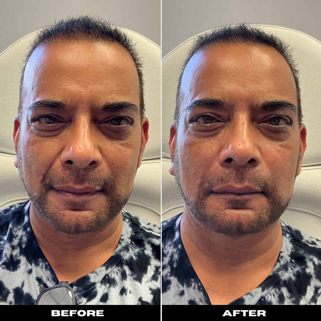 Before and After Image: Dermal Filler - front