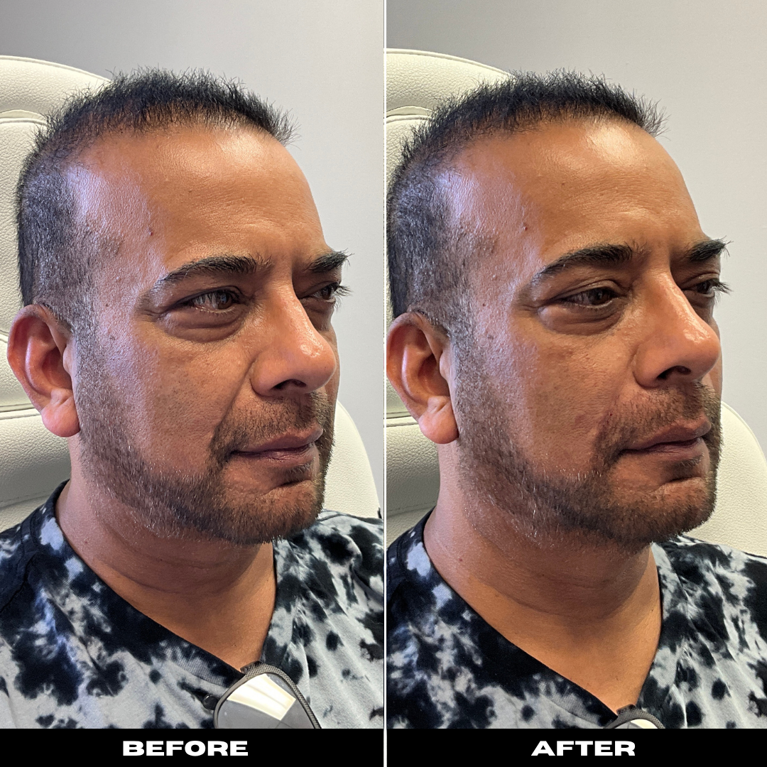 Before and After Image: Dermal Filler - right-front-oblique