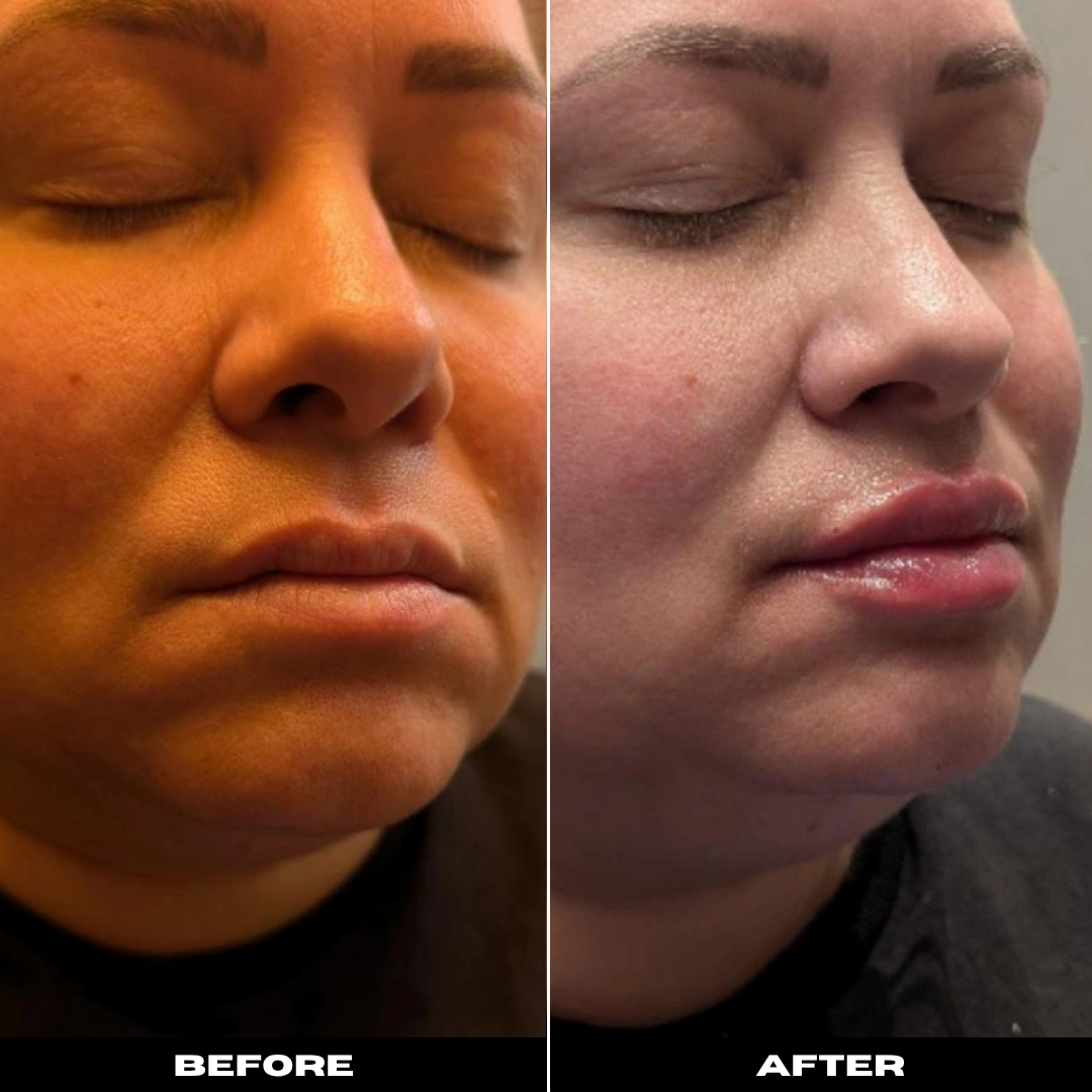 Before and After Image: Dermal Filler - right-front-oblique