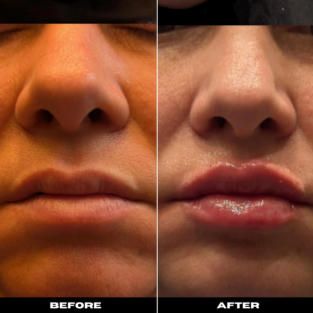 Before and After Image: Dermal Filler - right-front-oblique