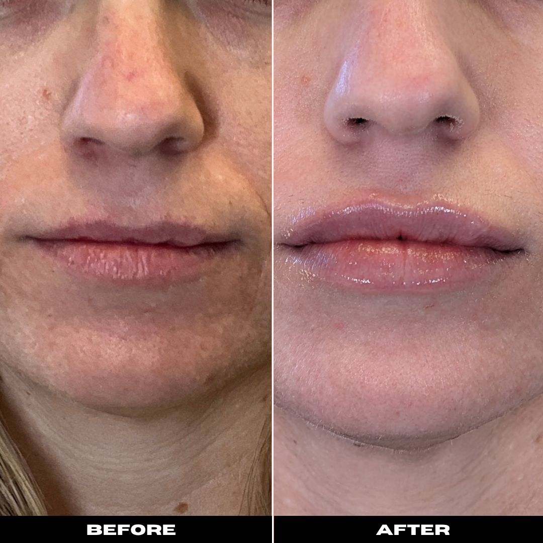 Before and After Image: Dermal Filler - front