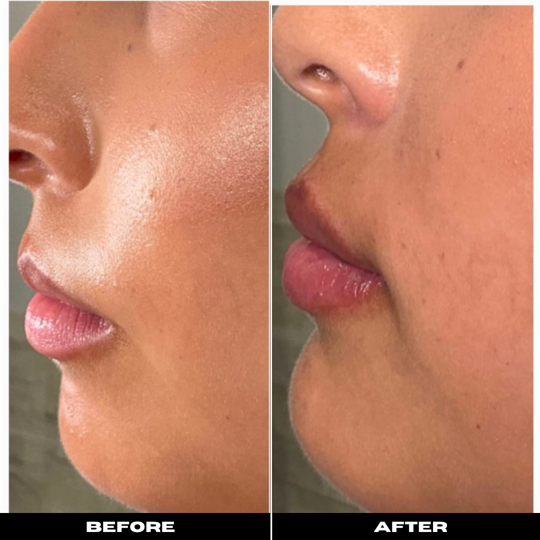 Before and After Image: Dermal Filler - left-side