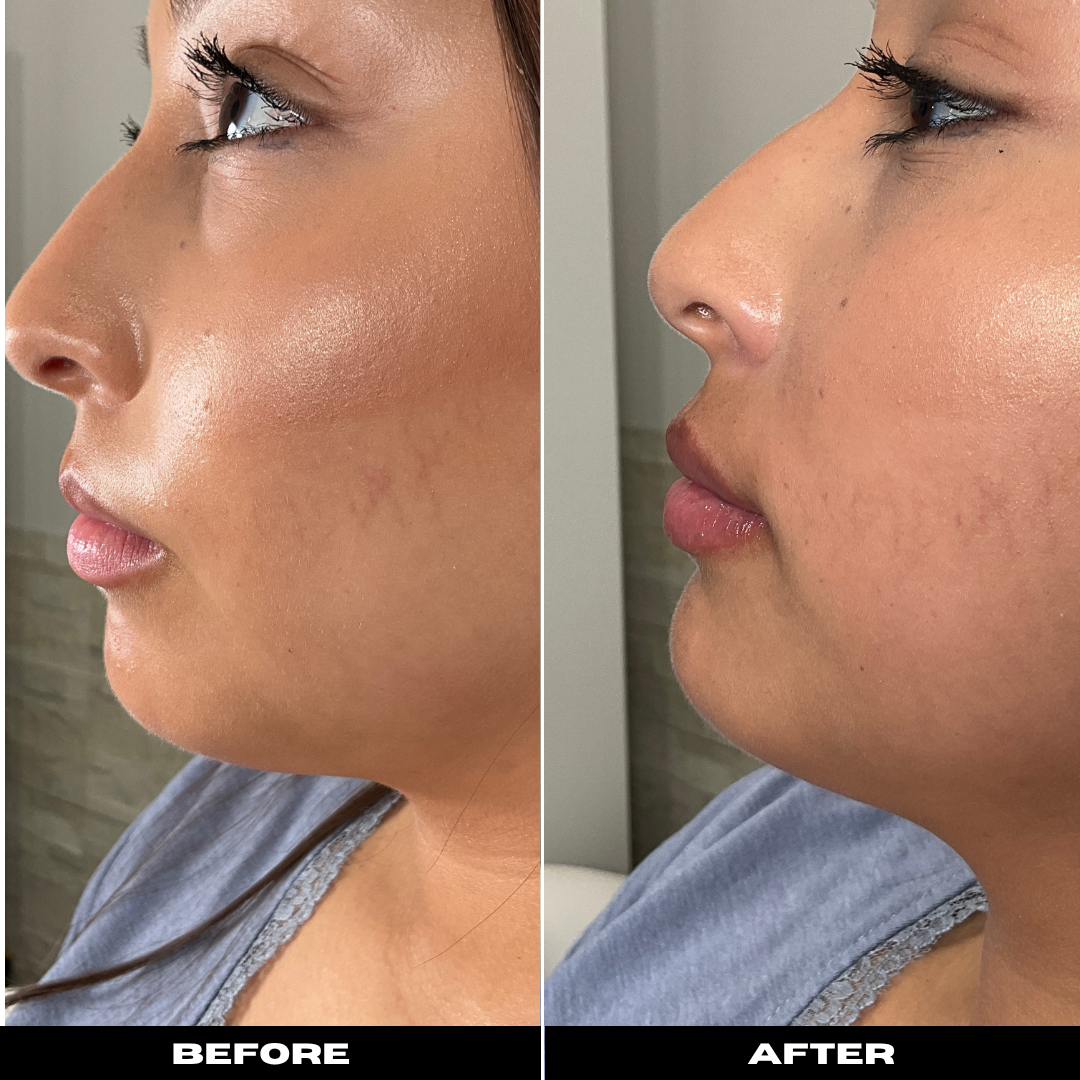 Before and After Image: Dermal Filler - left-side