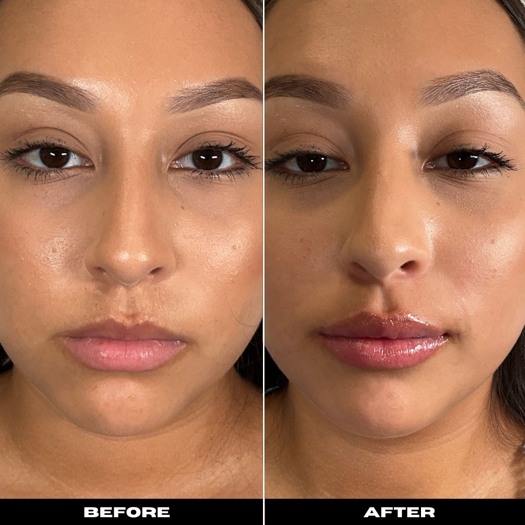 Before and After Image: Dermal Filler - front