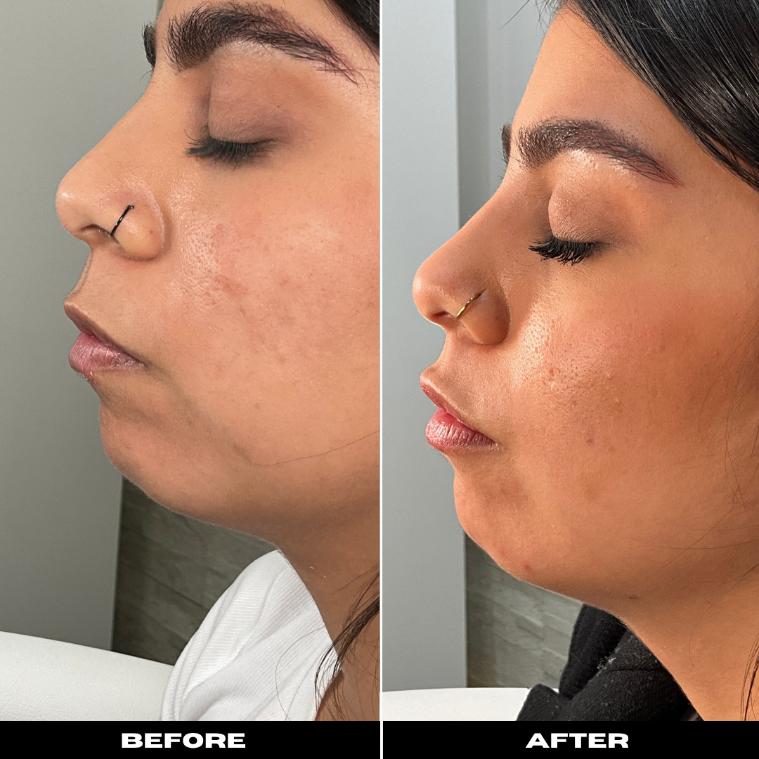 Before and After Image: Dermal Filler - left-side
