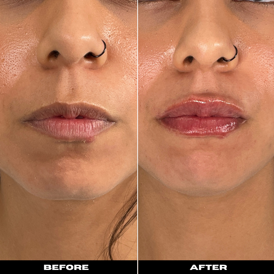 Before and After Image: Dermal Filler - front