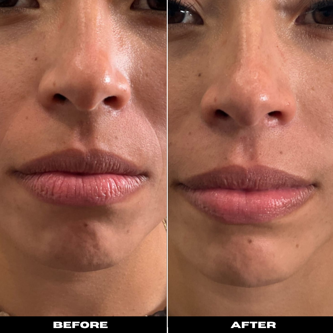 Before and After Image: Dermal Filler - front