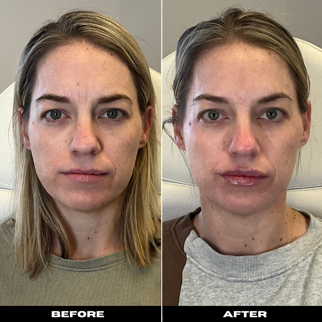 Before and After Image: Filler and Tox - front