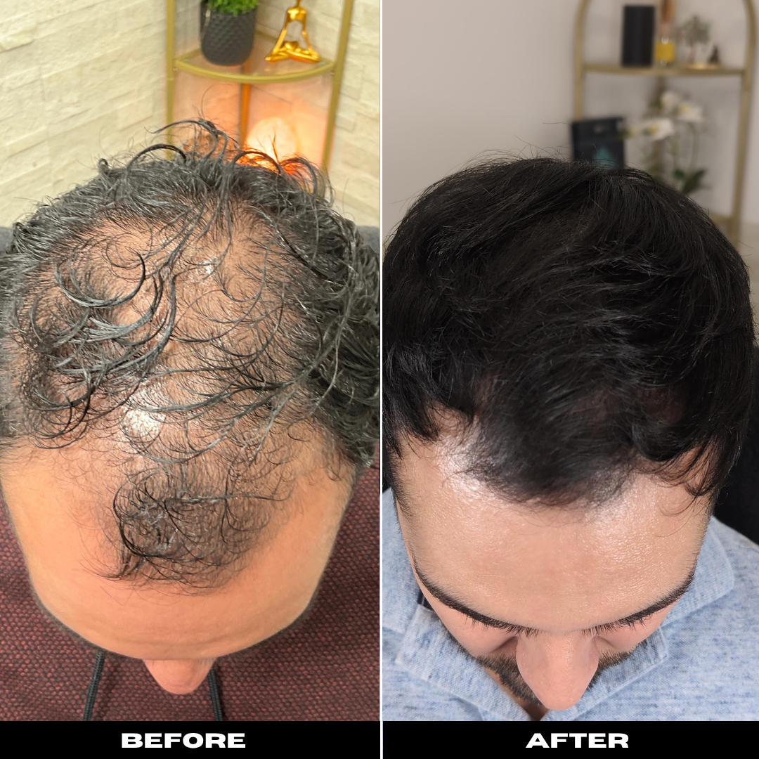 Before and After Image: Hair Rejuvenation - front