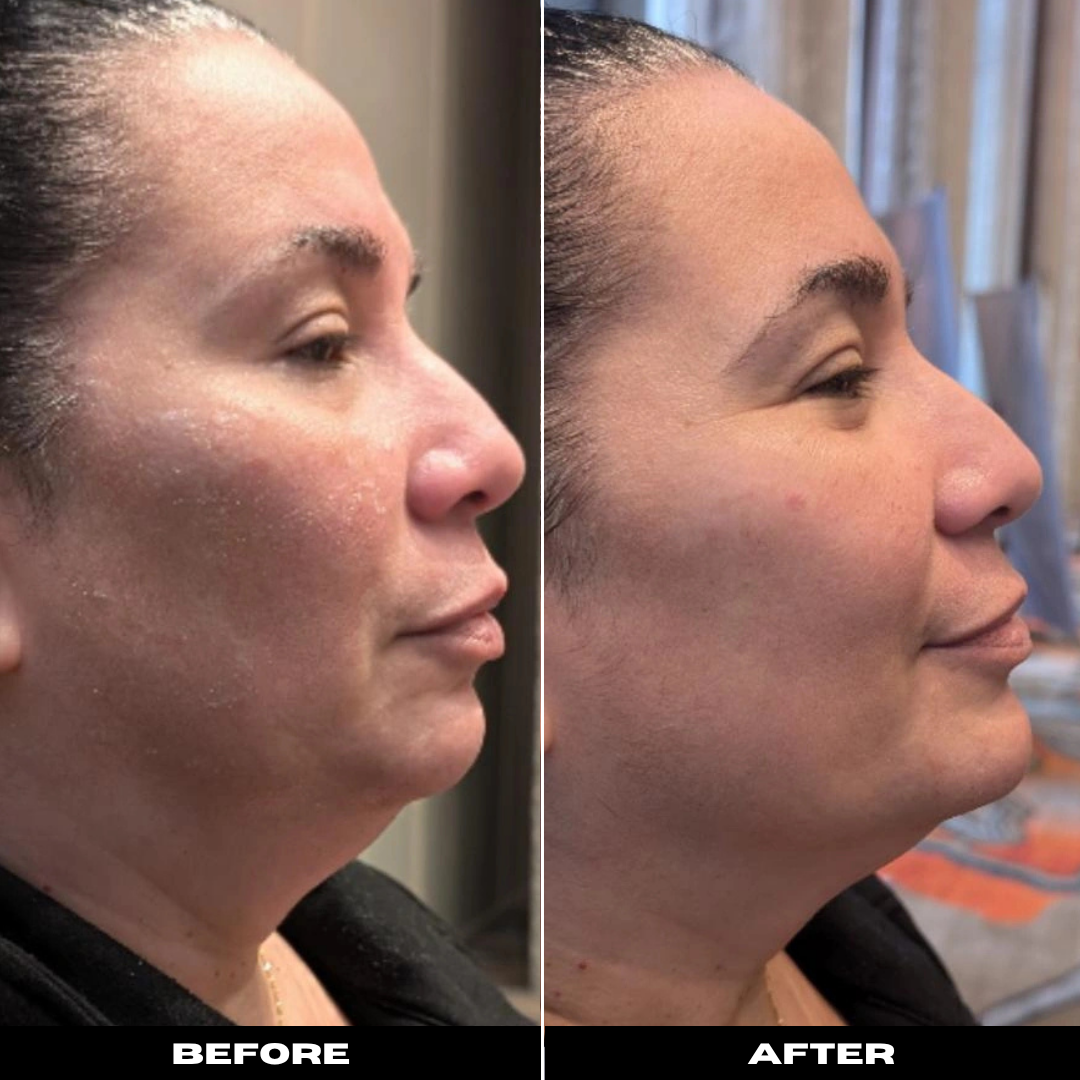 Before and After Image: Microneedling Facial - right-side