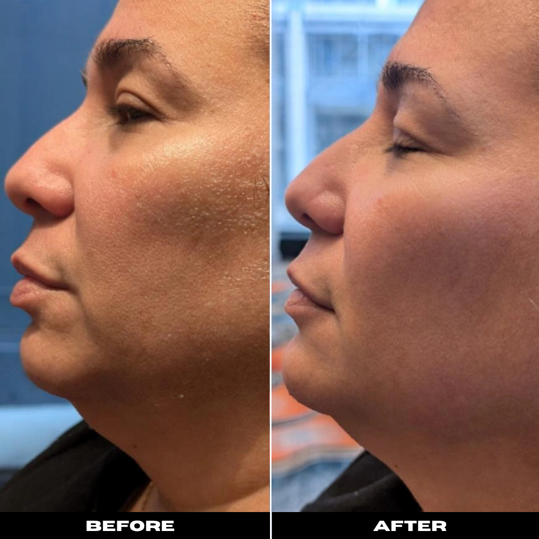 Before and After Image: Microneedling Facial - left-side