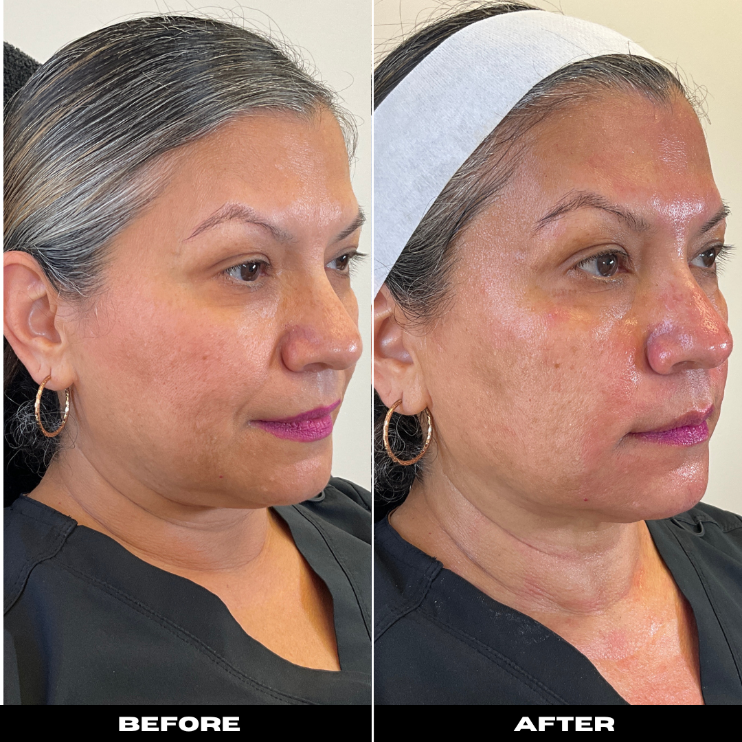 Before and After Image: Microneedling with PRP - right-front-oblique