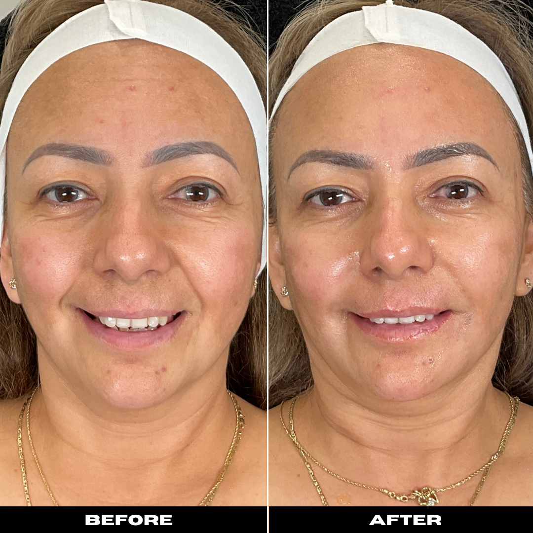 Before and After Image: Microneedling with PRP - front