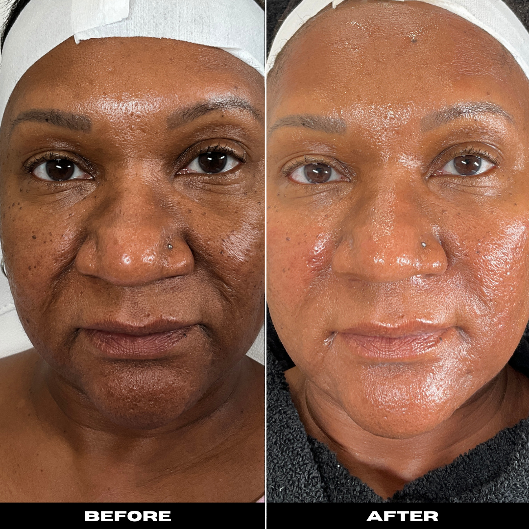 Before and After Image: Microneedling with PRP - front