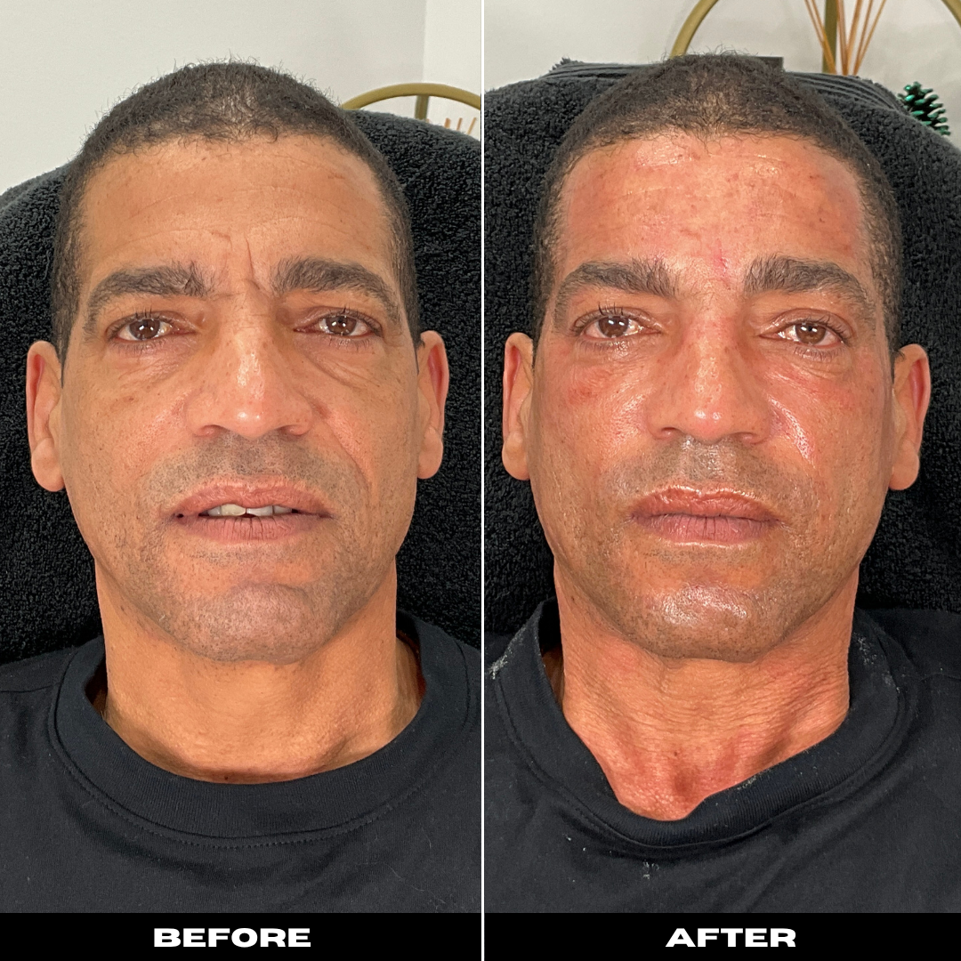Before and After Image: Microneedling with PRP - front