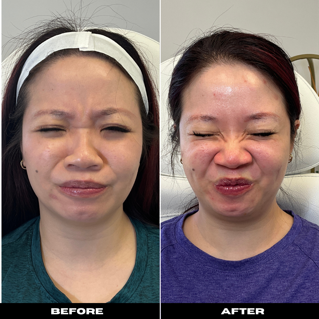 Before and After Image: Tox - front