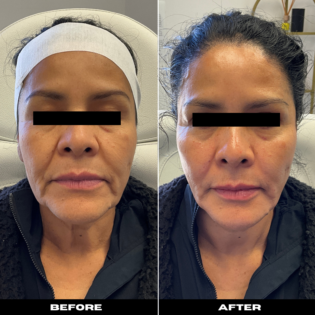 Before and After Image: Sculptra - front