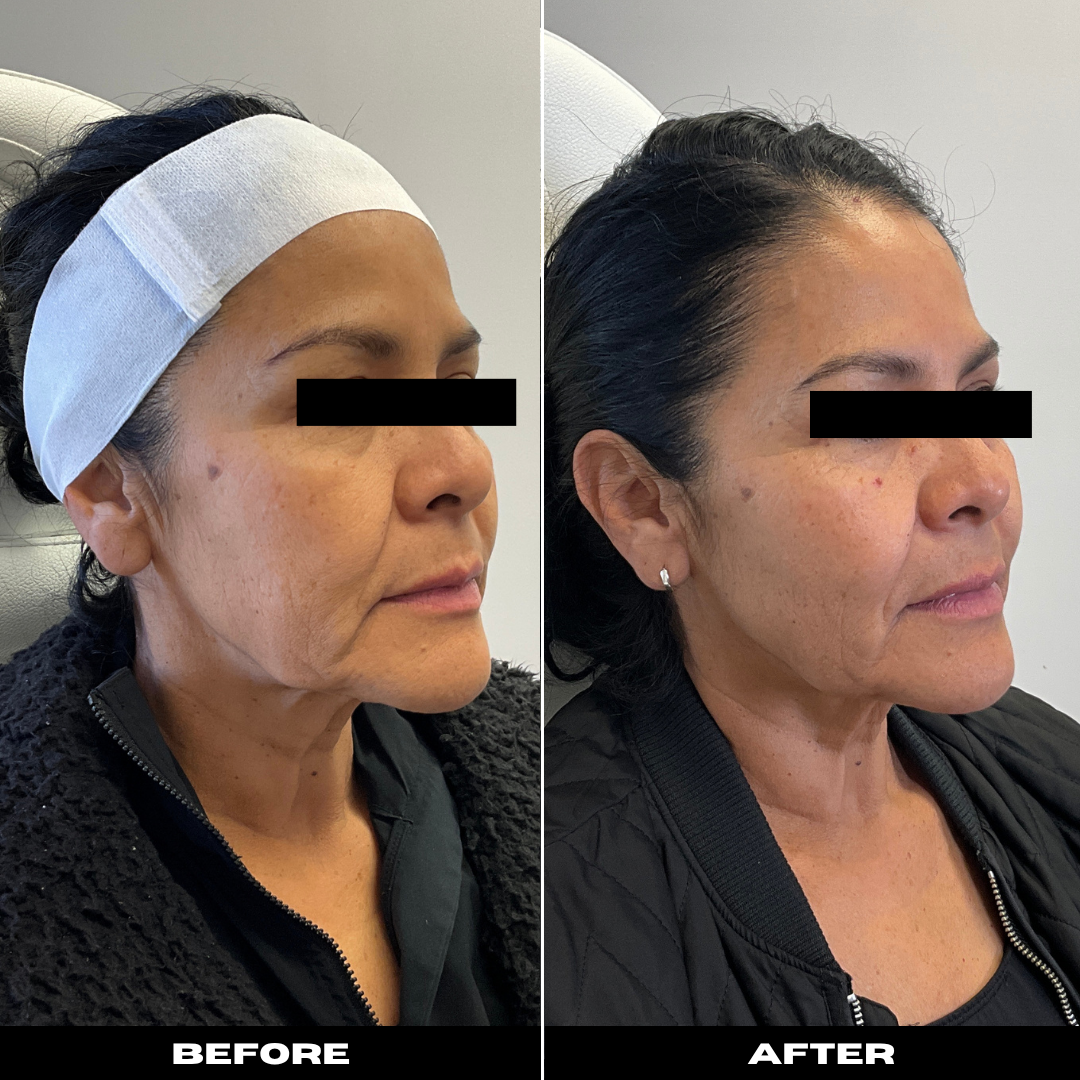 Before and After Image: Sculptra - right-front-oblique