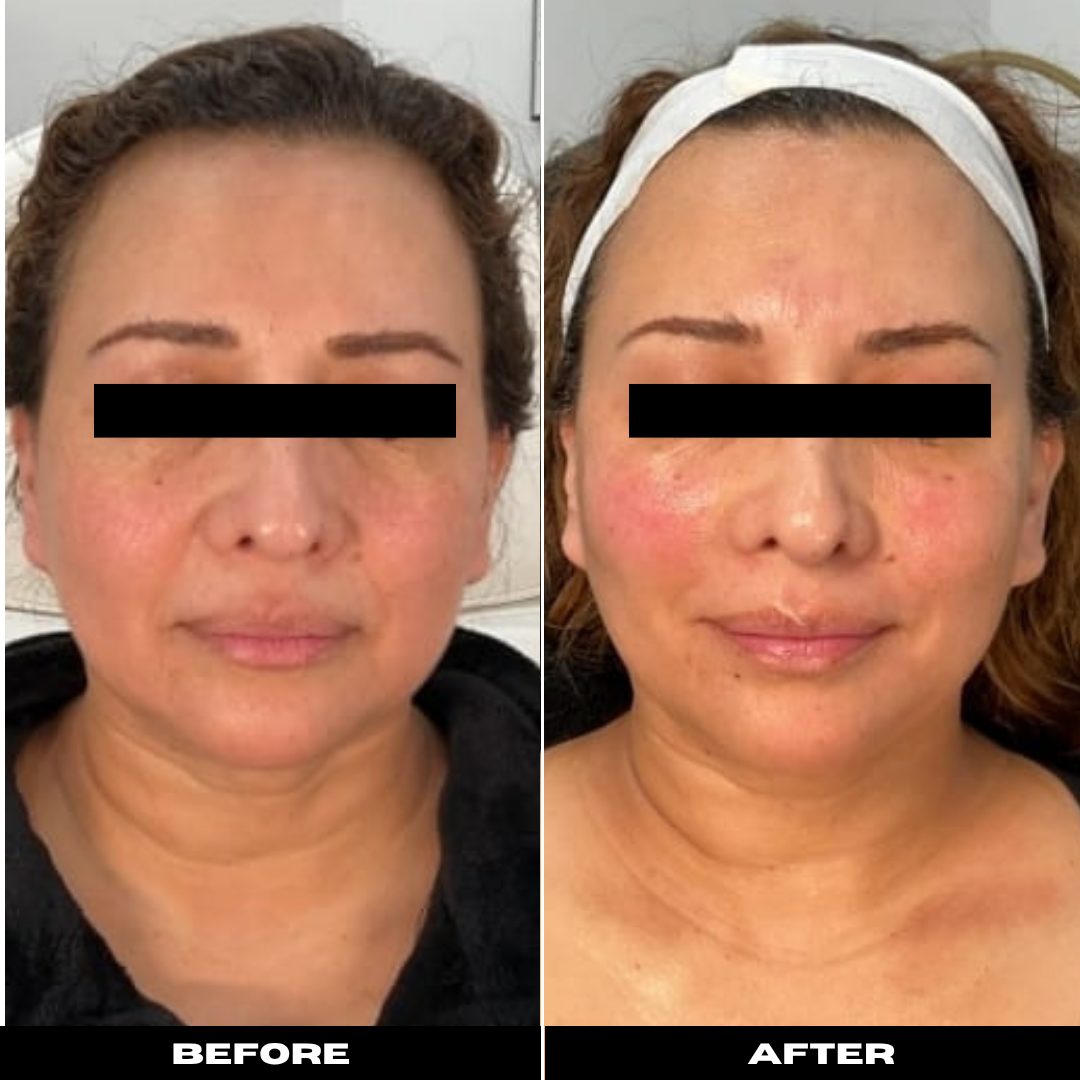 Before and After Image: Sculptra - front